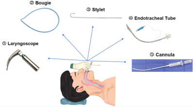 Laryngotracheal Stylet and Cannula